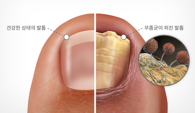 발톱무좀 완치 방법 원인 분석 바르는약 추천